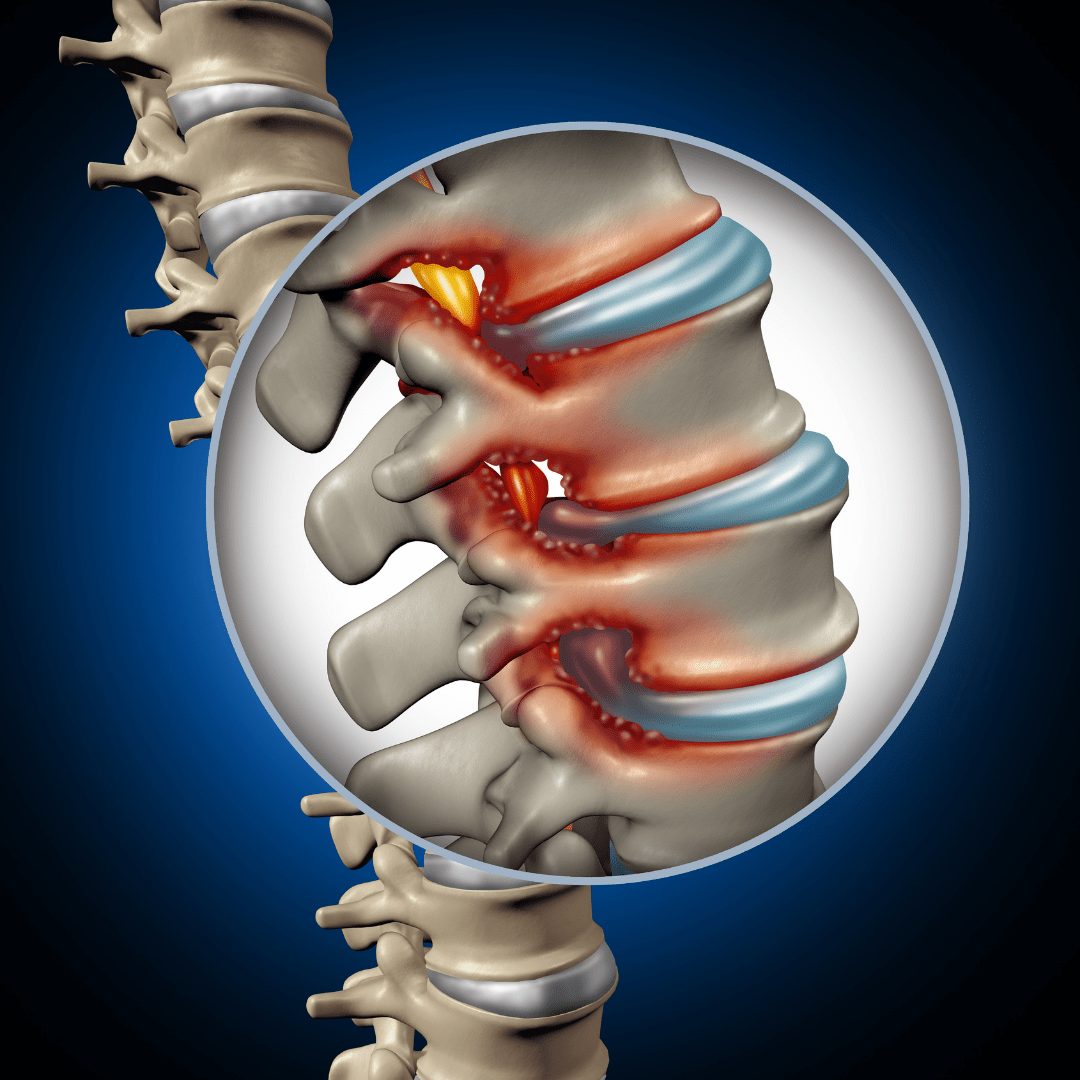 Spinal Stenosis