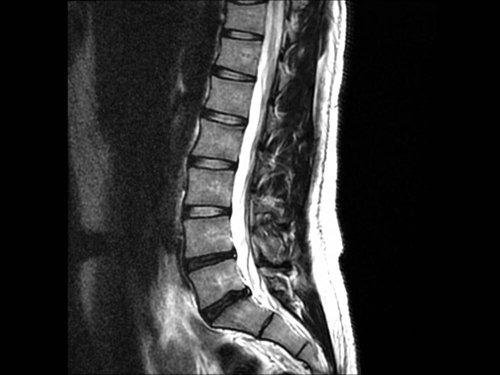 SpineMRI 1