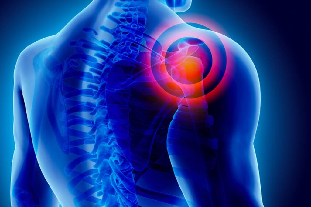 phyx you physiotherapy shoulder pain